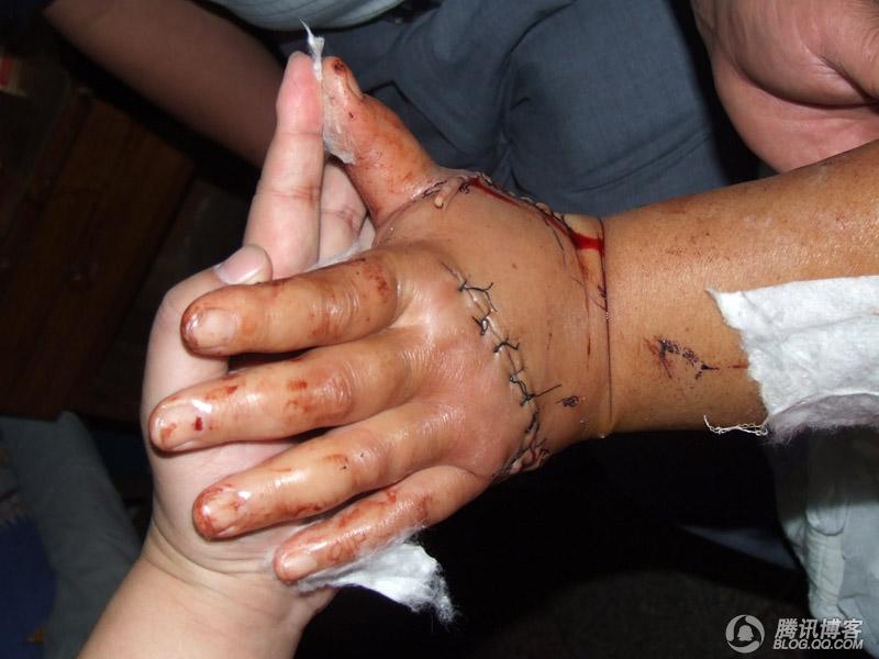 王永芝被砍伤的手